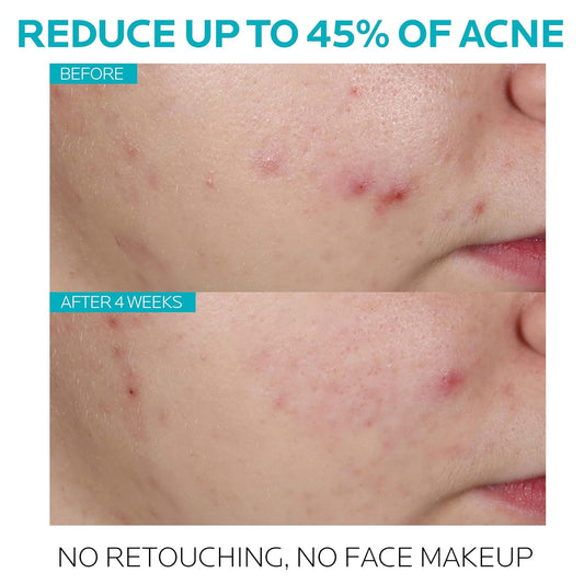 glycolic acid (aha) for accelerated cell turnover and improved skin tone and texture