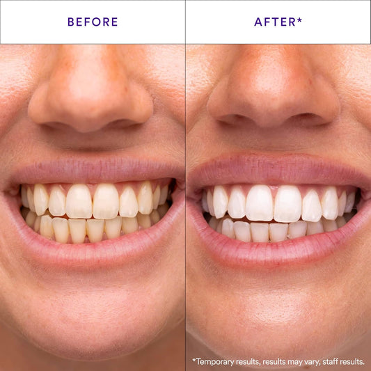 pap+ proprietary peroxide-free whitening formulation