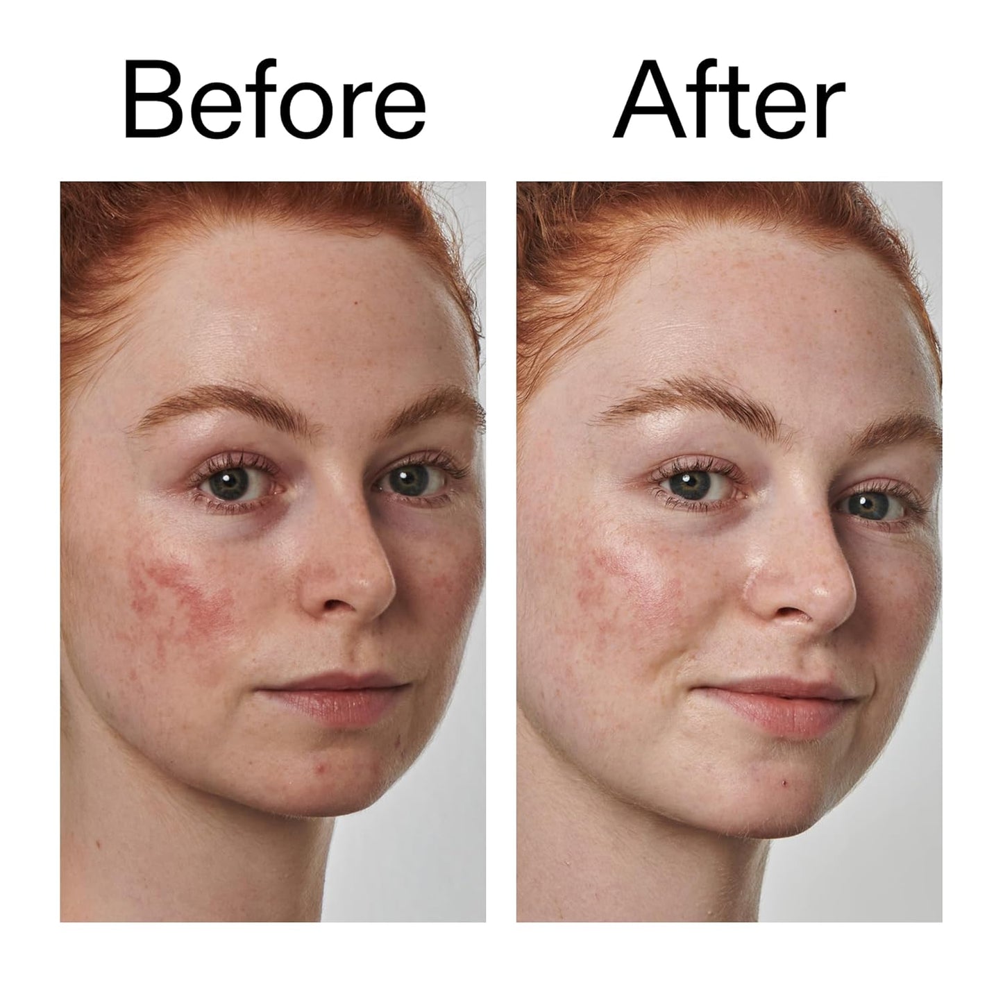The INKEY List SuperSolutions Azelaic Acid 10% Serum – Clean Vanity Staple for Minimalist Routines