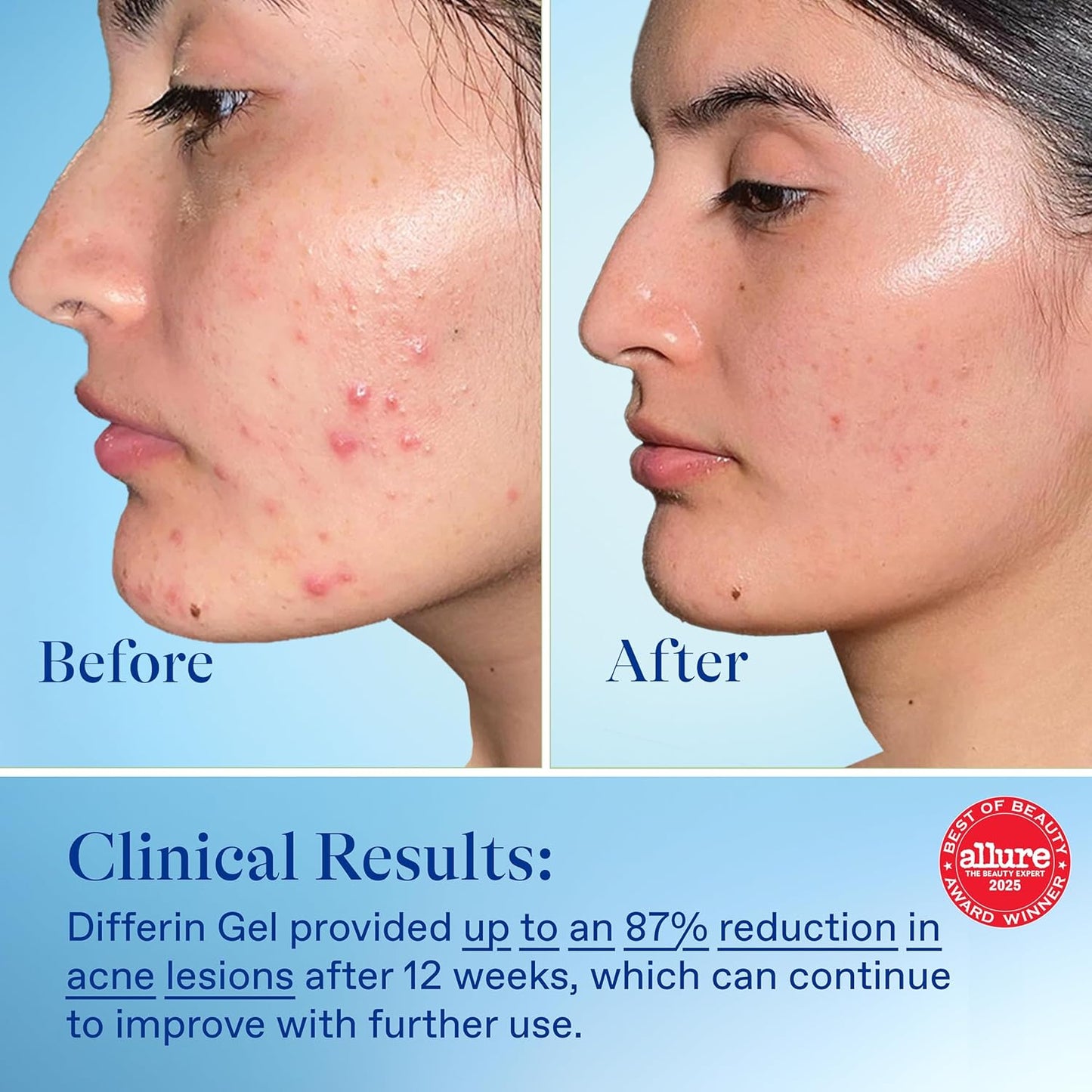 dermatologist recommended for acne-prone and sensitive skin types