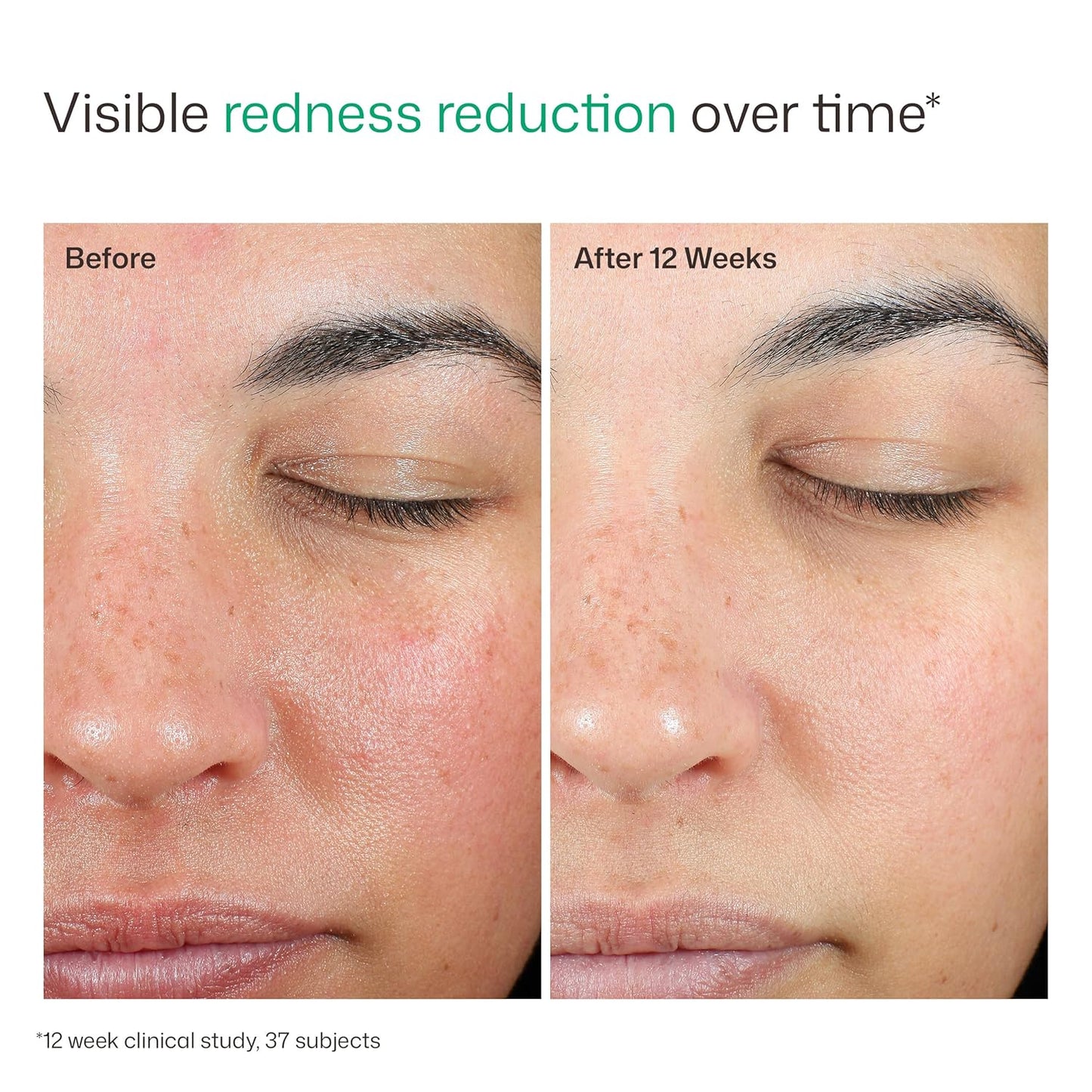 EltaMD UV Skin Recovery Sunscreen SPF 50 – Chemical-Free Mineral Protection for Reactive Skin