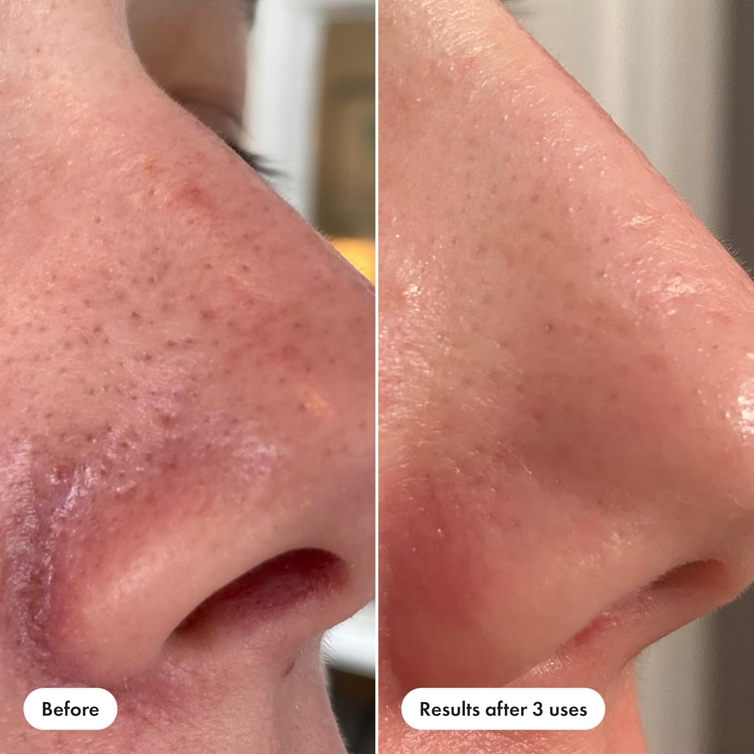 flexible dosing: full-face 2-3x weekly or targeted t-zone spot treatment