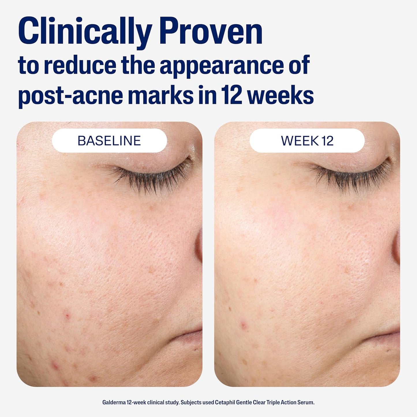 hypoallergenic, fragrance-free, oil-free, and non-comedogenic formulation