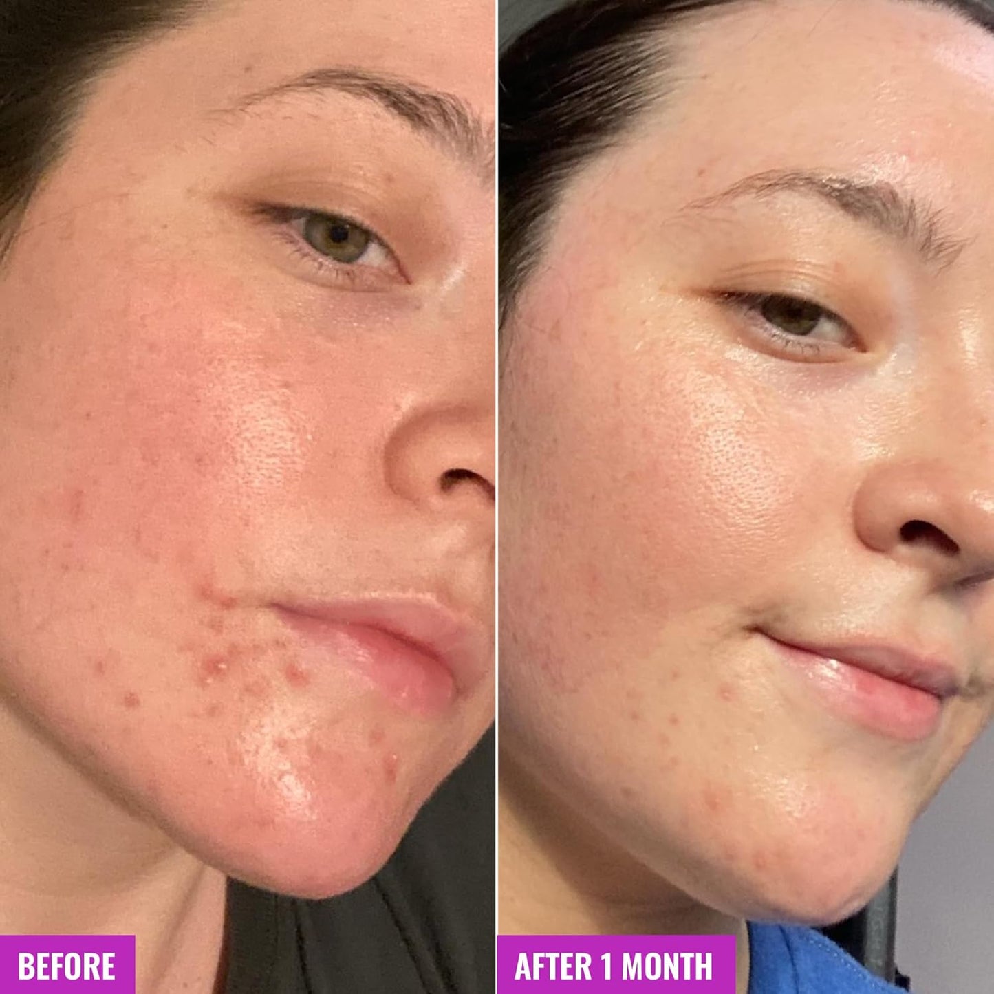kaolin clay to balance excess sebum