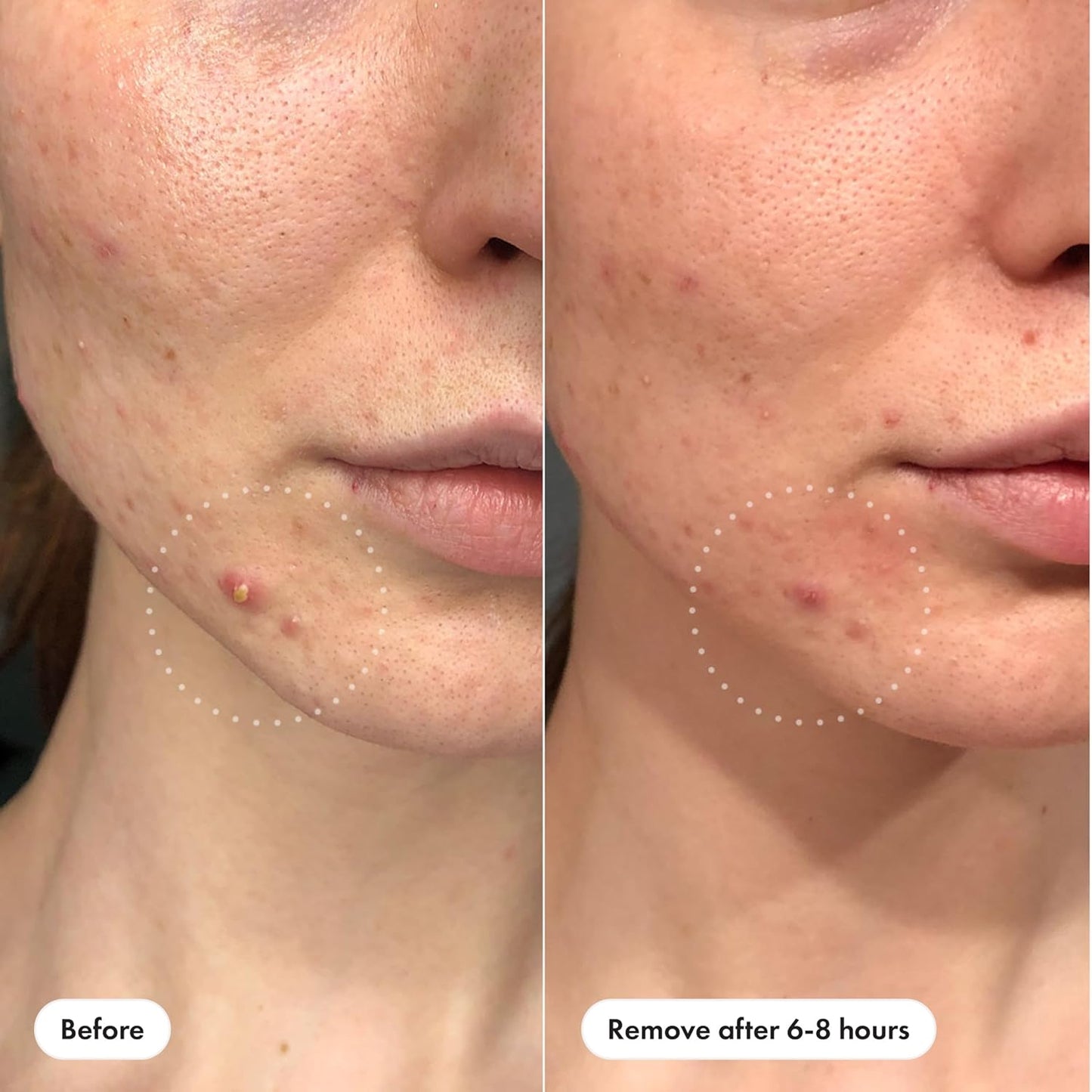 medical-grade hydrocolloid that gently absorbs pus and oil from whiteheads
