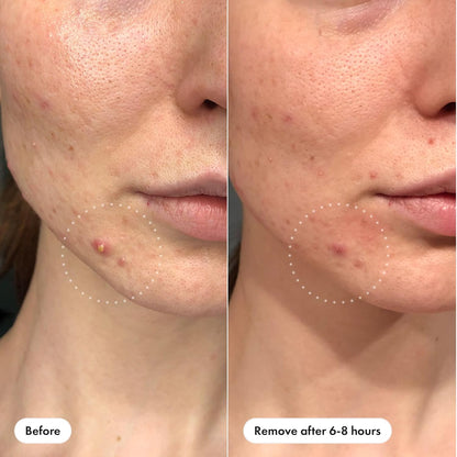 medical-grade hydrocolloid that gently absorbs pus and oil from whiteheads