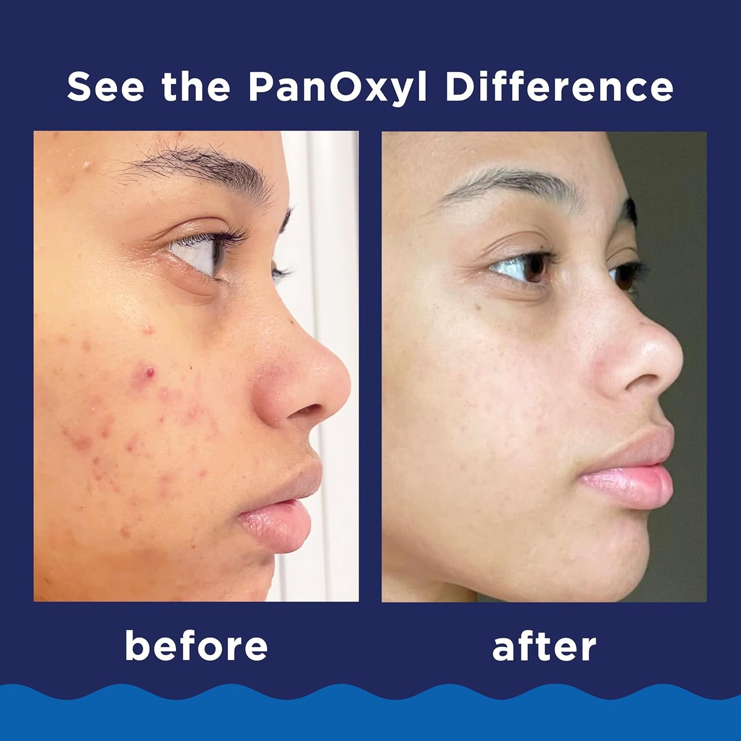moisturizer-enriched to counteract dryness and irritation