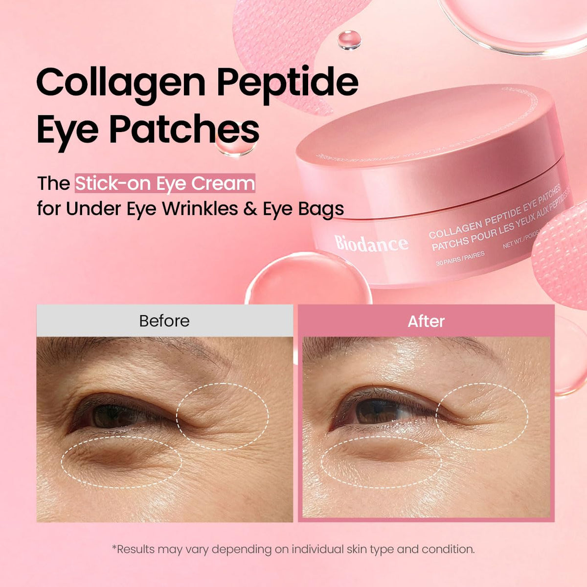 multi-zone design suitable for under-eyes, smile lines, forehead, and neck