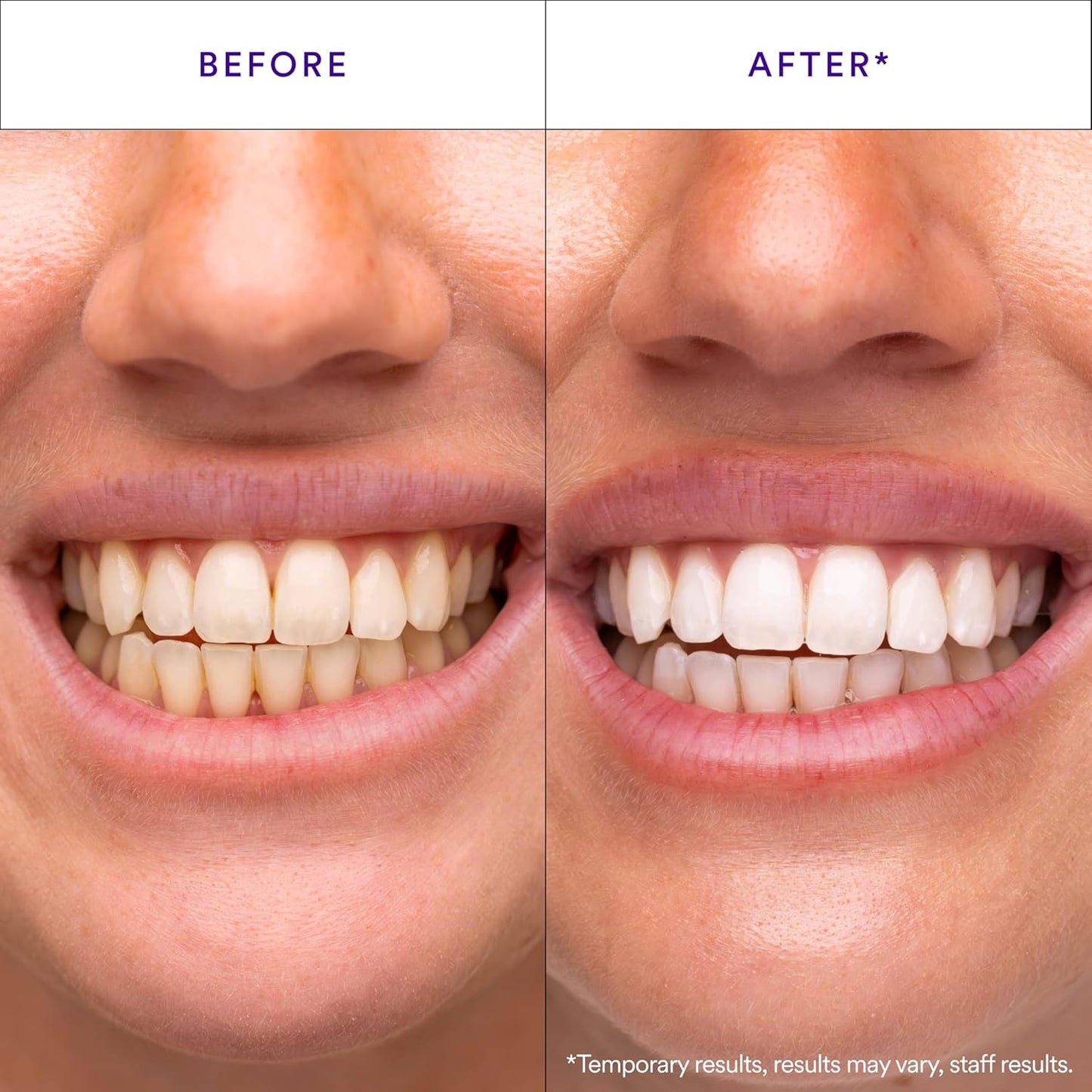 pap+ proprietary peroxide-free whitening formulation