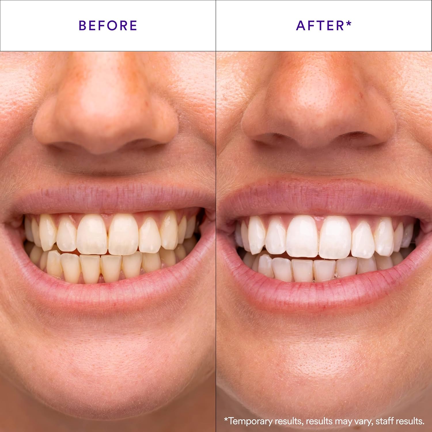 pap+ proprietary peroxide-free whitening formulation