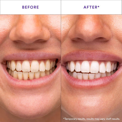 pap+ proprietary peroxide-free whitening formulation