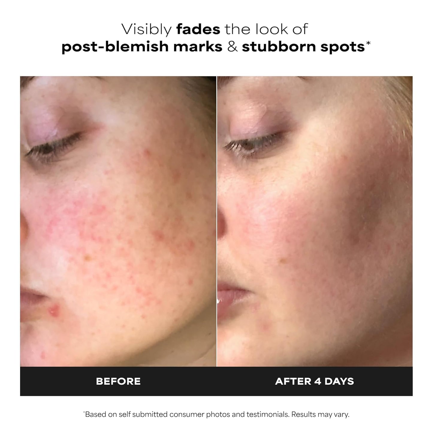 salicylic acid (bha) gentle exfoliator for unclogging pores and smoothing texture