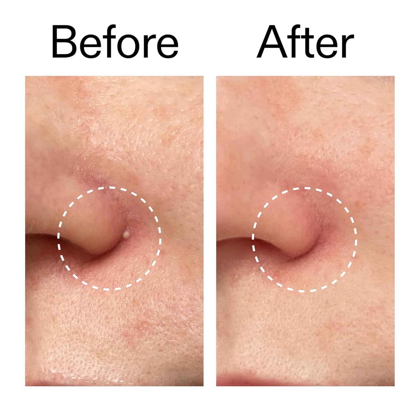 The INKEY List Hydrocolloid Invisible Pimple Patches Thoughtful Skincare Gift for Her Birthday Surprise