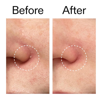 The INKEY List Hydrocolloid Invisible Pimple Patches Thoughtful Skincare Gift for Her Birthday Surprise